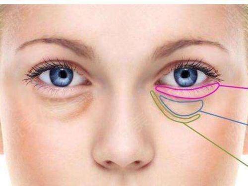 外切眼袋的過(guò)程是什么樣子的？