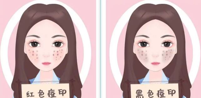 臉上紅色痘印幾個月都不消怎么辦？紅色痘印應該怎么消除？