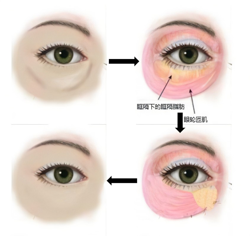 消除眼袋的方法有哪些？