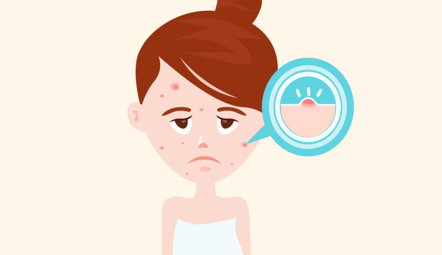 青春痘有救了嗎？聽說青春痘也有疫苗了？