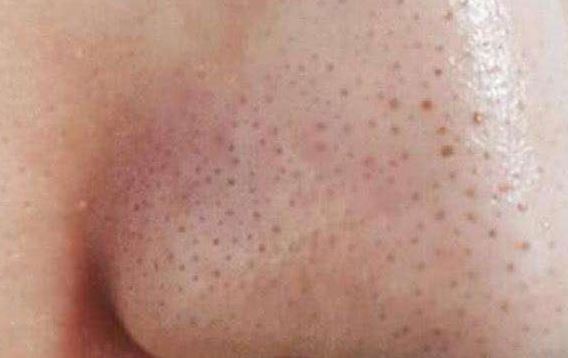 清潔面膜哪個(gè)牌子可以快速祛黑頭？趙薇、薇婭 推薦的紐西之謎泥膜真的好用嗎？